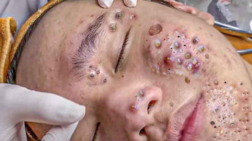 Acne scars treatment .