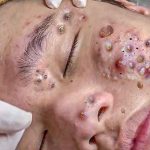 Acne scars treatment .