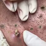 Reacts to Oddly Shaped Ear Cyst