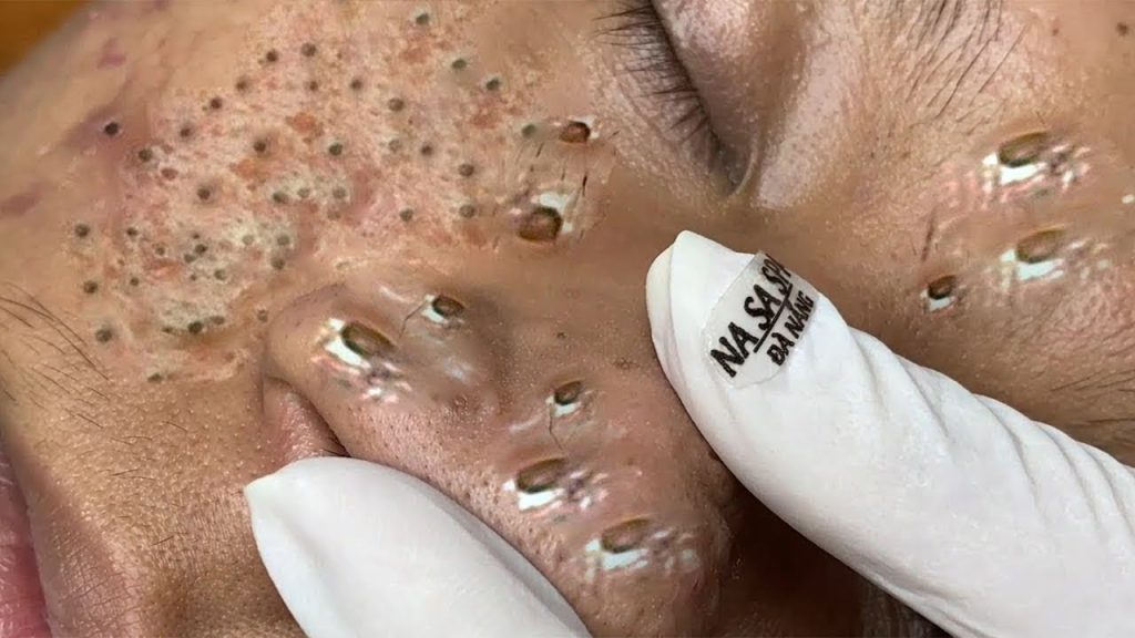Relaxing pimlpe popping, Blackheads and Whiteheads removal