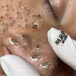 Relaxing pimlpe popping, Blackheads and Whiteheads removal