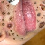 Satisfying Blackhead Extraction