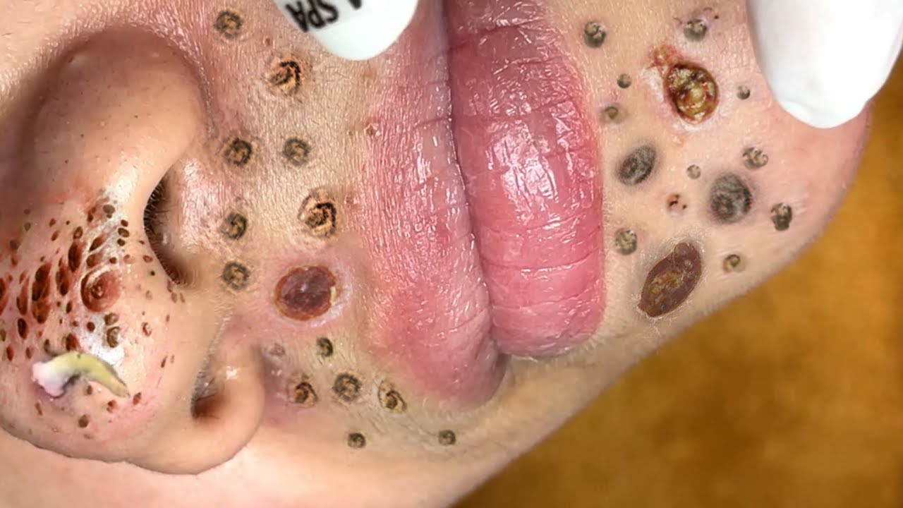 Satisfying Blackhead Extraction