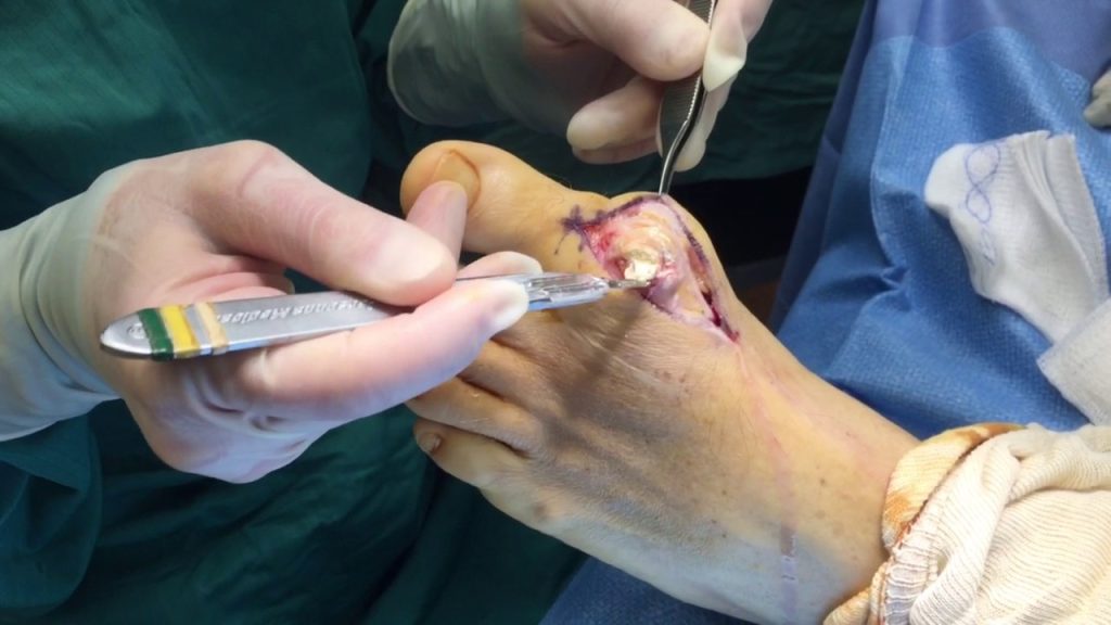 How to remove an Ingrown Nail, Ingrown Toenails.