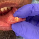Mucocele (Snot Bubble) Removal on Bottom Lip