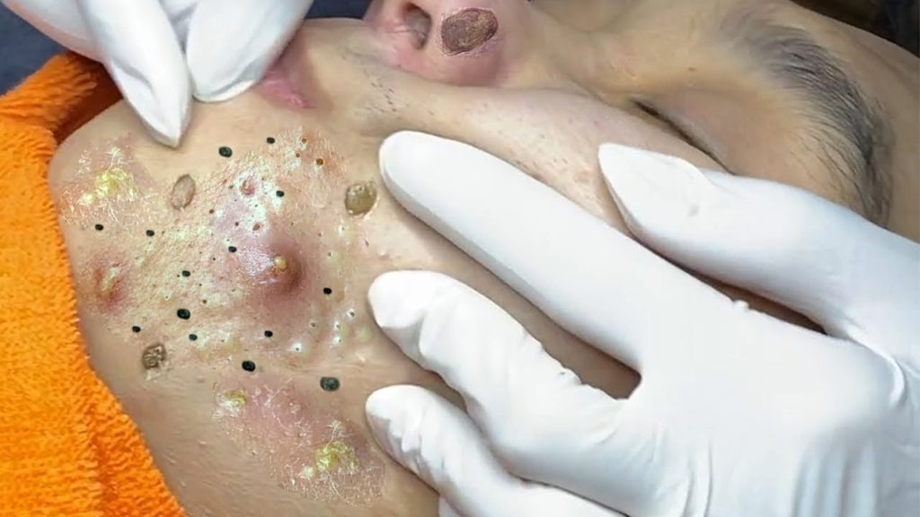 Acne prone skin
