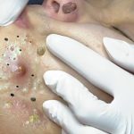 Acne prone skin