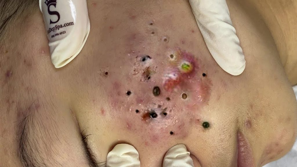 blackhead​ acne pimple removal