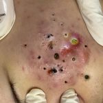blackhead​ acne pimple removal
