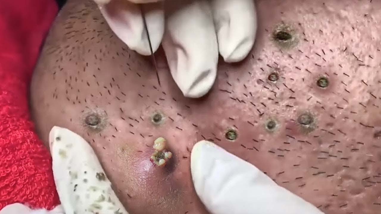 Reacts to Oddly Shaped Ear Cyst