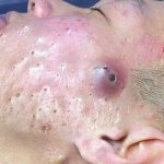 Blackhead therapy