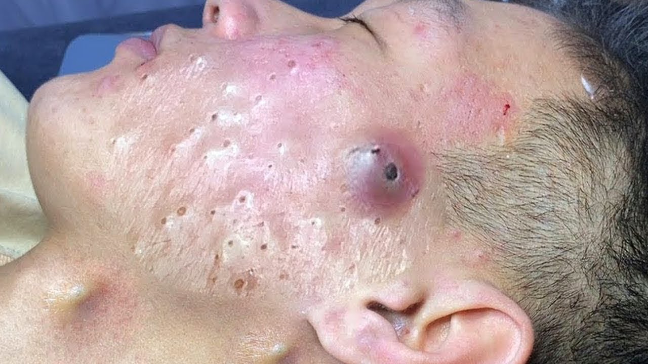 Blackhead therapy