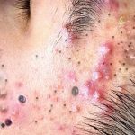 Extraction Blackheads
