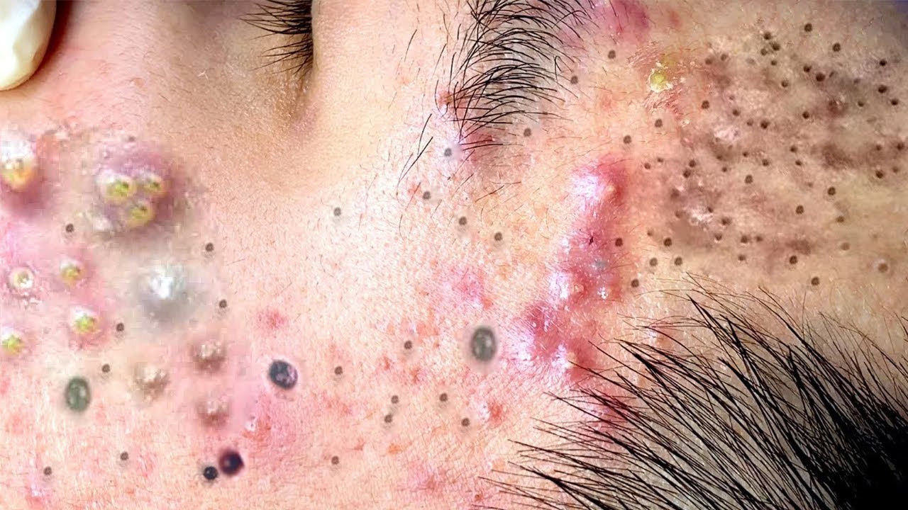 Extraction Blackheads