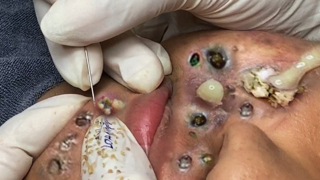 The BEST BLACKHEAD & Acne Remedy in the World