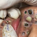 The BEST BLACKHEAD & Acne Remedy in the World