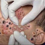 Removal Pimple Popping