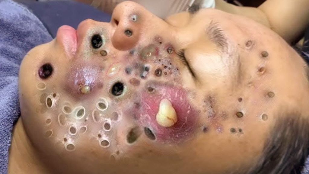 When blackheads get this massive… you know it’s extraction time!