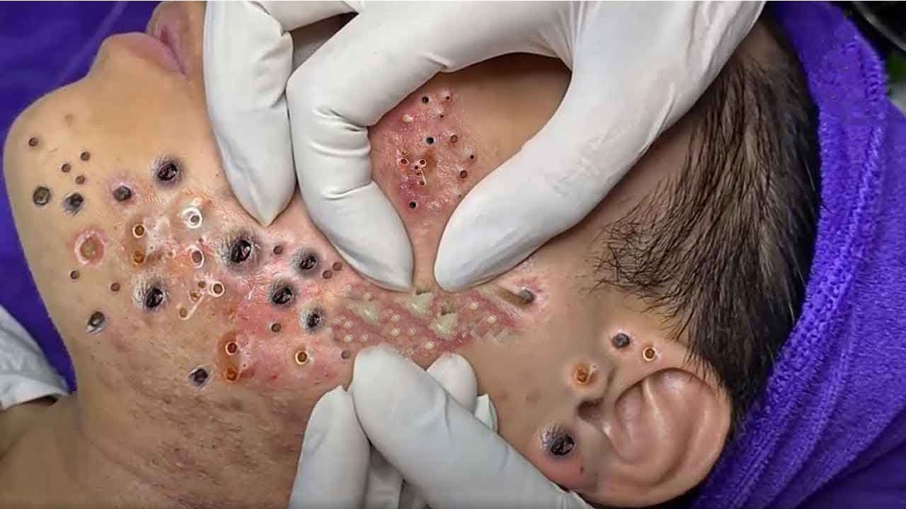 Removal Pimple Popping