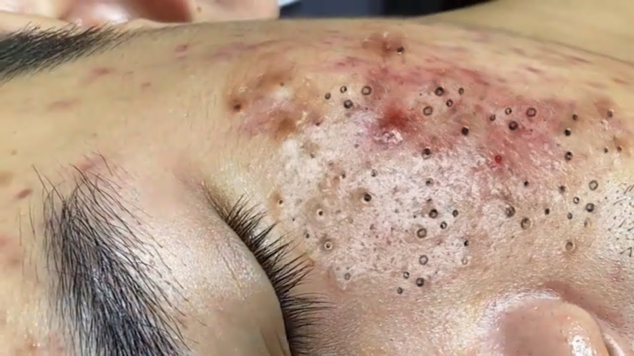 Deep Facial Cleansing: Blackheads Around Piercing