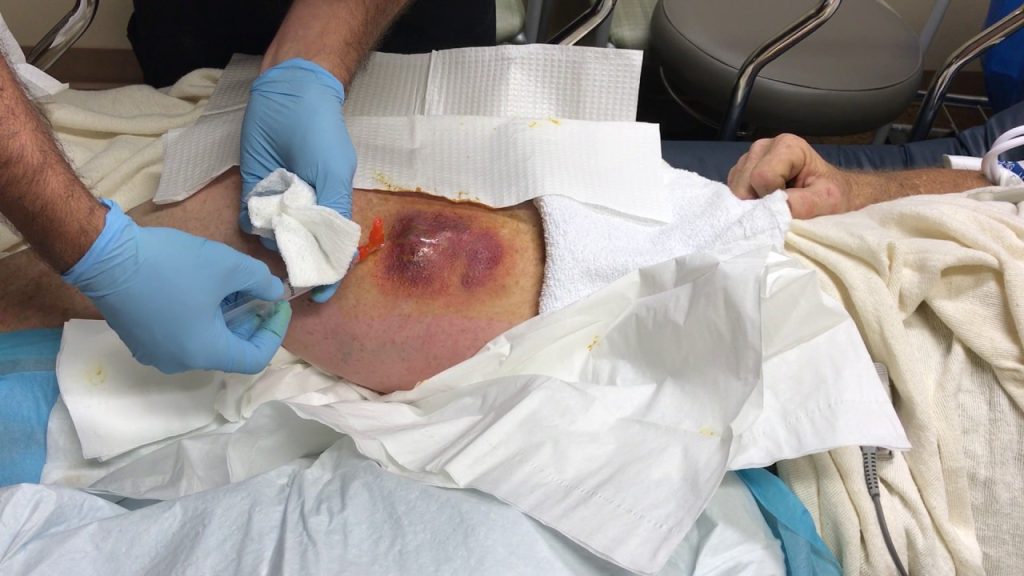 Raw Abscess Drainage