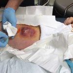Raw Abscess Drainage