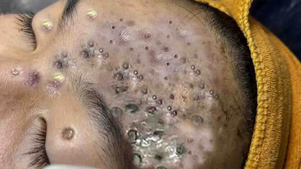 Remove blackheads on the face