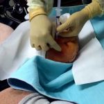 Abscess in left stump drainage