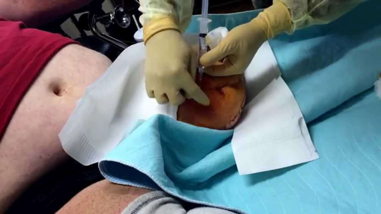 Abscess in left stump drainage