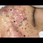 relaxing blackheads removal pimple popping videos blackheads removal large blackheads popping
