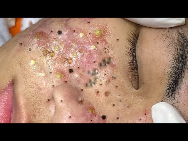 relaxing blackheads removal pimple popping videos blackheads removal large blackheads popping