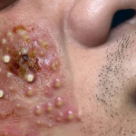 Eliminates bacteria that cause acne on the face
