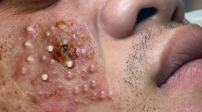 Eliminates bacteria that cause acne on the face