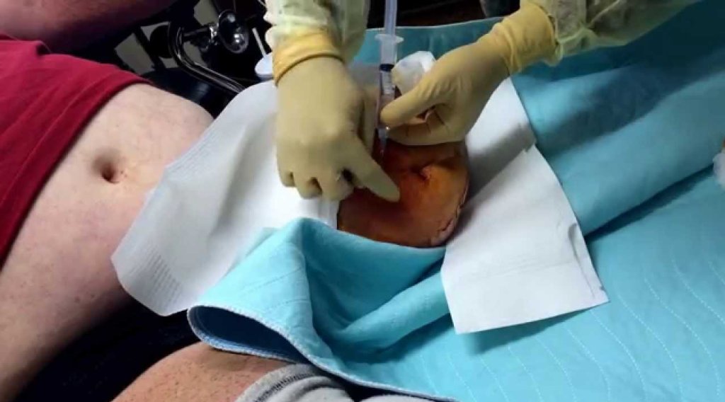 Abscess in left stump drainage