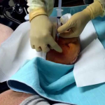 Abscess in left stump drainage
