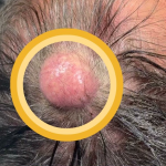 how do you​ Get rid of acne scars