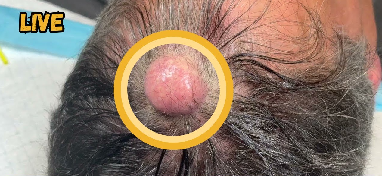 how do you​ Get rid of acne scars