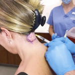Pharmacy creams for acne marks