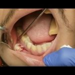you Tooth abscess