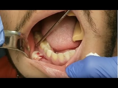 you Tooth abscess