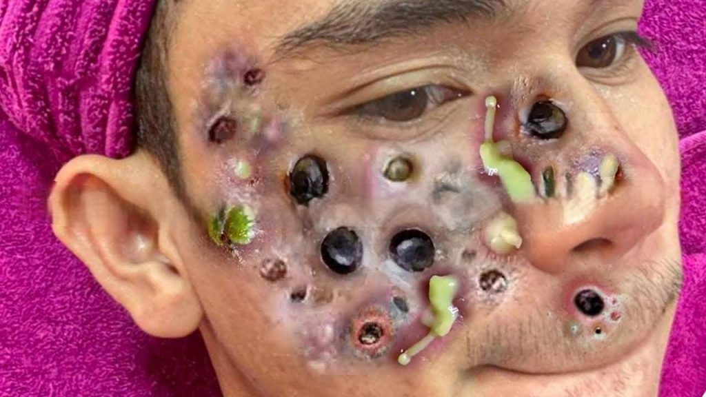 What Your Acne Means By Location According to A Dermatologist