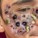 What Your Acne Means By Location According to A Dermatologist