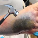 Foot Smashed By Water Bottle!! 💥 Foot Hematoma