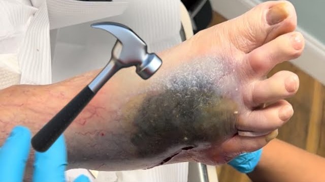 Foot Smashed By Water Bottle!! 💥 Foot Hematoma
