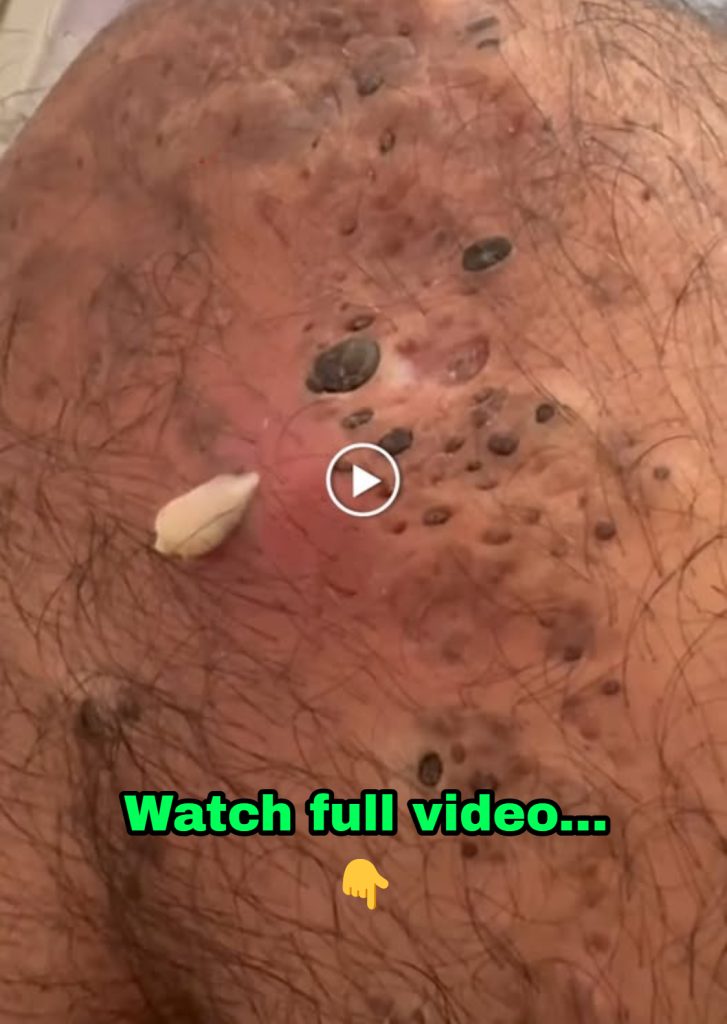 Personal trainer, 25, told by doctors she had the ‘worst acne they’ve ever seen’ shares her striking before and after pictures following six months on medication and skincare products