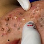 Treatments for Nodular Acne: What are My Options?