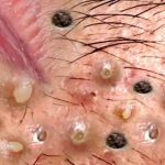 How to Best Treat Acne When You Have Dry Skin