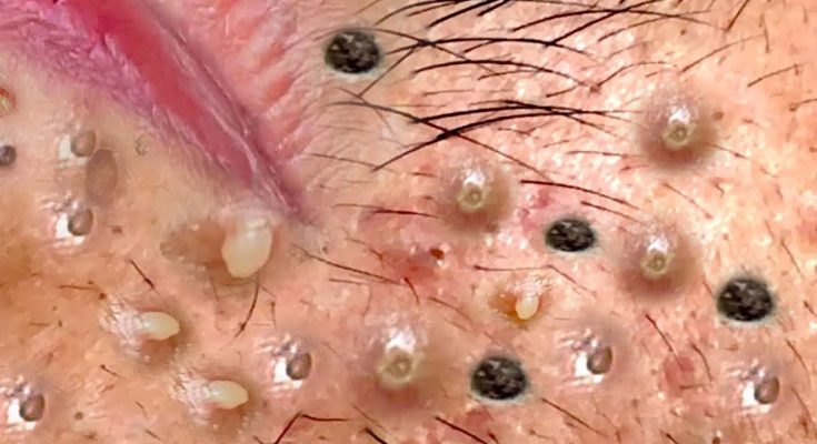 How to Best Treat Acne When You Have Dry Skin